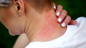 Vespa, Calabrone, Zecca, Medusa, Vipera, Cimice, Zanzara: cosa fare in caso di puntura