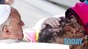 È morto Vinicio Riva, l'uomo sfigurato baciato da papa Francesco