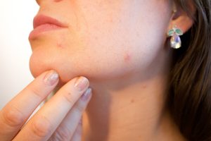 Psoriasi: sintomi, cause, rimedi e prevenzione