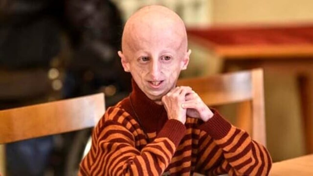 E' morto Sammy, ucciso da un malore al ristorante. Una vita a lottare contro la progeria