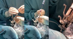 Un nuovo braccio elettronico rivoluziona la neurochirurgia al San Bortolo di Vicenza